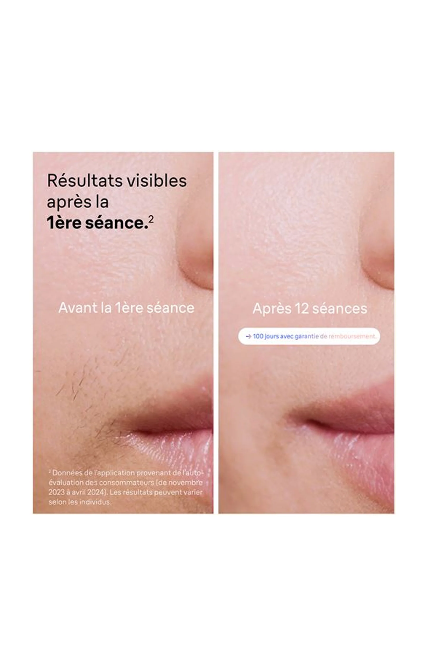 Épilateur lumière pulsée - Smart IPL 7 Skin i·expert PL7147 - Corps & visage - Image 3