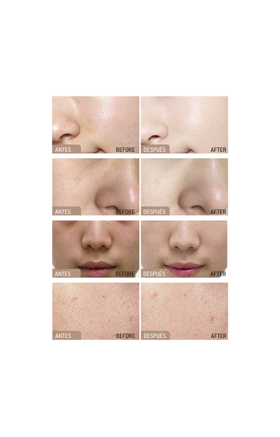 Appareil radiofréquence - Visage - Image 3